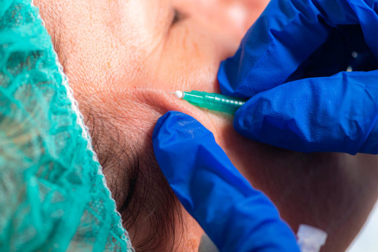 Fios de sustentação corporal Os diferentes tipos de fios, tem como função, tracionamento da pele promovendo efeito lift é uma grande estimulação de colágeno. Eles são completamente reabsorvidos pelo organismo em até 18 meses e podem ser recolocados.A escolha do fio dependerá na análise feita pelo profissional , visando a indicação, contraindicação e finalidade. Não sendo indicado para excesso de pele, nesse caso é indicado cirurgia para remoção de pele.