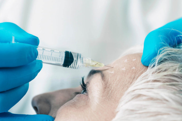 Toxina botulínica
Dentre as diversas indicações estéticas, a mais comum, são as rugas, mas e utilizada na hiperidrose, sorriso gengival, nos poros abertos, cicatrizes, rosáceas, diminui oleosidade da pele.
Atua na diminuição da contração muscular, amenizando as rugas e linhas de expressão. Sua aplicação é feita de maneira simples e segura, com resultado final e satisfatório após 15 dias da aplicação.