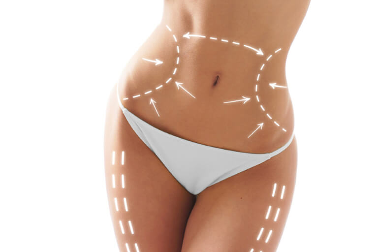 Biostimulator de colágeno É composto por ácido polilatico ou hidroxiapatita de cálcio, estimulando uma intensa produção de colágeno, melhorando gradativamente a sustentação e elasticidade. É necessário no mínimo 3 sessões, com intervalos de 30 dias. Ele pode ser aplicado em qualquer região do corpo, como face, pescoço, mãos, entre outras áreas que apresente flacidez.